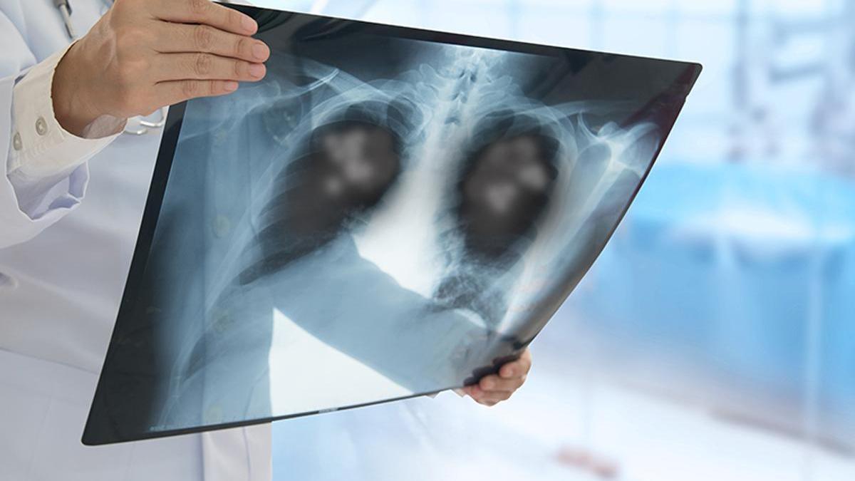 Kanserde tehlikeli artış! Hiç sigara içmeyenlerde de görülme sıklığı arttı! En büyük nedeni hava kirliliği